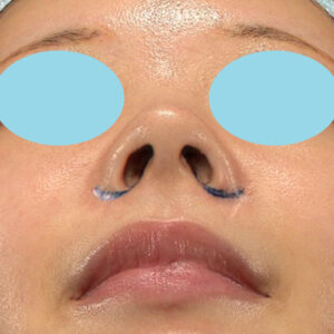 新宿ラクル美容外科クリニック　山本厚志　「小鼻縮小+α法」　デザイン　１１月３日