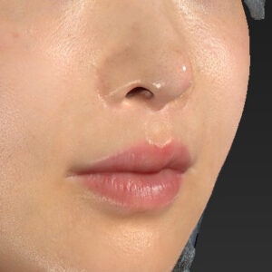 新宿ラクル美容外科クリニック　山本厚志　「貴族手術（鼻翼基部プロテーゼ）」　手術直後　１１月２０日