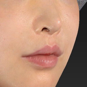 新宿ラクル美容外科クリニック　山本厚志　「貴族手術（鼻翼基部プロテーゼ）」　手術後１週間目　１１月２０日