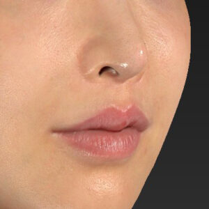 新宿ラクル美容外科クリニック　山本厚志　「貴族手術（鼻翼基部プロテーゼ）」　手術後１ヶ月目　１１月２０日