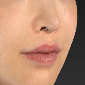 新宿ラクル美容外科クリニック　山本厚志　「貴族手術（鼻翼基部プロテーゼ）」　手術後２ヶ月目　１１月２０日