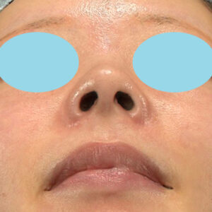 新宿ラクル美容外科クリニック　山本厚志　「小鼻縮小+α法」　手術後２ヶ月目　１２月３日