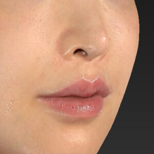 新宿ラクル美容外科クリニック　山本厚志　「貴族手術（鼻翼基部プロテーゼ）」　手術後３ヶ月目　１１月２０日