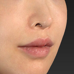 新宿ラクル美容外科クリニック　山本厚志　「貴族手術（鼻翼基部プロテーゼ）」　手術後６ヶ月目　１１月２０日