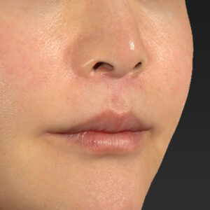 新宿ラクル美容外科クリニック　山本厚志　「人中短縮術（リップリフト）＋口角挙上（スマイルリップ）」　手術後６ヶ月目　１月１０日