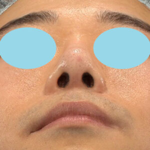 「鼻中隔延長＋耳介軟骨移植＋鼻尖形成＋鼻柱下降＋猫手術＋真皮脂肪移植（鼻尖）＋鼻プロテーゼ隆鼻術」　新宿ラクル美容外科クリニック　２０代女性　手術後６ヶ月目　２月１２日