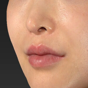 新宿ラクル美容外科クリニック　山本厚志　「貴族手術（鼻翼基部プロテーゼ）」　手術前　１１月２０日