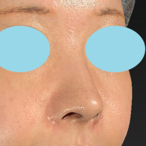 新宿ラクル美容外科クリニック　山本厚志　「小鼻縮小+α法」　手術前　１１月３日