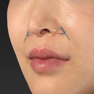 新宿ラクル美容外科クリニック　山本厚志　「貴族手術（鼻翼基部プロテーゼ）」　デザイン　１１月２０日