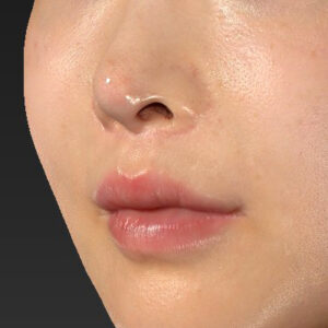 新宿ラクル美容外科クリニック　山本厚志　「貴族手術（鼻翼基部プロテーゼ）」　手術直後　１１月２０日