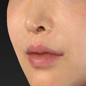 新宿ラクル美容外科クリニック　山本厚志　「貴族手術（鼻翼基部プロテーゼ）」　手術後１週間目　１１月２０日