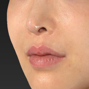 新宿ラクル美容外科クリニック　山本厚志　「貴族手術（鼻翼基部プロテーゼ）」　手術後１ヶ月目　１１月２０日