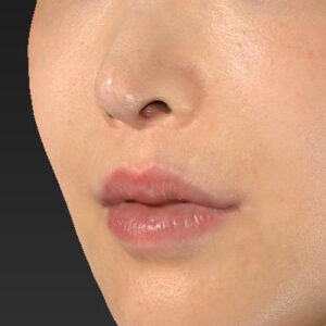 新宿ラクル美容外科クリニック　山本厚志　「貴族手術（鼻翼基部プロテーゼ）」　手術後２ヶ月目　１１月２０日