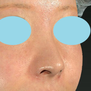 新宿ラクル美容外科クリニック　山本厚志　「小鼻縮小+α法」　手術後２ヶ月目　１２月３日