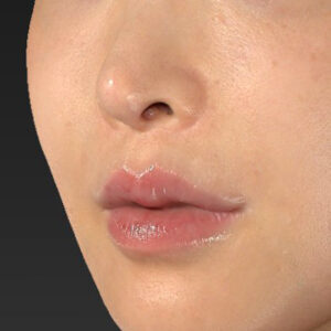 新宿ラクル美容外科クリニック　山本厚志　「貴族手術（鼻翼基部プロテーゼ）」　手術後３ヶ月目　１１月２０日