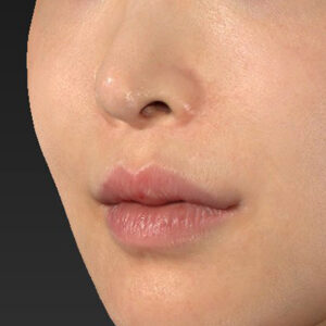 新宿ラクル美容外科クリニック　山本厚志　「貴族手術（鼻翼基部プロテーゼ）」　手術後６ヶ月目　１１月２０日