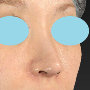 「耳介軟骨移植＋鼻尖縮小（close法）＋小鼻縮小+α＋貴族手術」　新宿ラクル美容外科クリニック　３０代女性　手術後６ヶ月目　１２月２２日
