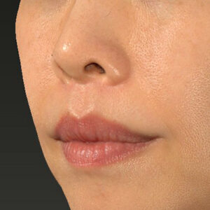 新宿ラクル美容外科クリニック　山本厚志　「人中短縮術（リップリフト）」　手術後６ヶ月目　２月１４日