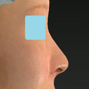 新宿ラクル美容外科クリニック　山本厚志　「小鼻縮小+α法」　手術後２ヶ月目　１２月３日