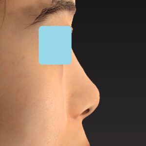 「小鼻縮小+α＋鼻尖縮小（close法）」　新宿ラクル美容外科クリニック　２０代女性　手術後６ヶ月目　２月５日