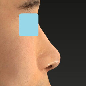 「鼻中隔延長＋耳介軟骨移植＋鼻尖形成＋鼻柱下降＋猫手術＋真皮脂肪移植（鼻尖）＋鼻プロテーゼ隆鼻術」　新宿ラクル美容外科クリニック　２０代女性　手術後６ヶ月目　２月１２日