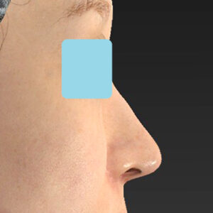 「耳介軟骨移植＋鼻尖縮小（close法）＋小鼻縮小+α＋貴族手術」　新宿ラクル美容外科クリニック　３０代女性　手術後６ヶ月目　１２月２２日