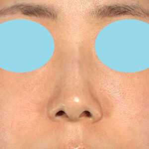 「鼻孔縁下降術」　新宿ラクル美容外科クリニック　山本厚志　３０代女性　手術前　１月３日