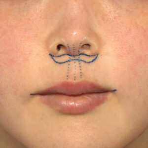 新宿ラクル美容外科クリニック　山本厚志　「人中短縮術（リップリフト）＋口角挙上（スマイルリップ）」　デザイン　１２月８日