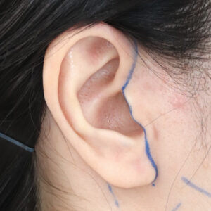 新宿ラクル美容外科クリニック　山本厚志　ナチュラルフェイスネックリフト　耳の傷痕　　デザイン　　１２月１２日