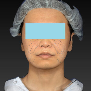 新宿ラクル美容外科クリニック　山本厚志　「アルテミスリフト＋ライポライフ脂肪吸引（メーラーファット+ジョールファット）」　デザイン　１２月１５日