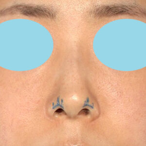 「鼻孔縁下降術」　新宿ラクル美容外科クリニック　山本厚志　３０代女性　デザイン　１月３日