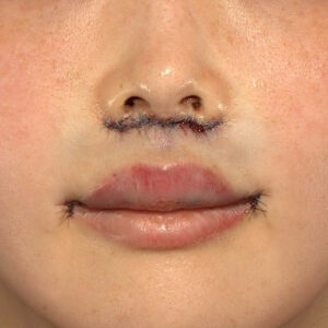 新宿ラクル美容外科クリニック　山本厚志　「人中短縮術（リップリフト）＋口角挙上（スマイルリップ）」　手術直後　１２月８日
