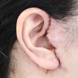 新宿ラクル美容外科クリニック　山本厚志　ナチュラルフェイスネックリフト　耳の傷痕　　手術直後　　１２月１２日