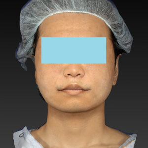 新宿ラクル美容外科クリニック　山本厚志　「アルテミスリフト＋ライポライフ脂肪吸引（メーラーファット+ジョールファット）」　手術直後　１２月１５日