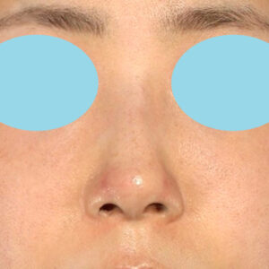 「鼻孔縁下降術」　新宿ラクル美容外科クリニック　山本厚志　３０代女性　手術後１週間目　１月３日