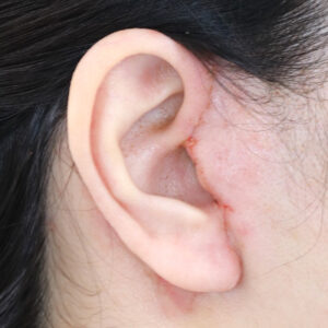 新宿ラクル美容外科クリニック　山本厚志　ナチュラルフェイスネックリフト　耳の傷痕　　手術後１週間目　　１２月１２日