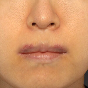 新宿ラクル美容外科クリニック　山本厚志　「外側人中短縮術（上口唇挙上術）修正 + 口角挙上（スマイルリフト）修正」　手術後１週間目　１２月１３日