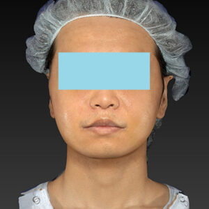 新宿ラクル美容外科クリニック　山本厚志　「アルテミスリフト＋ライポライフ脂肪吸引（メーラーファット+ジョールファット）」　手術後１週間目　１２月１５日