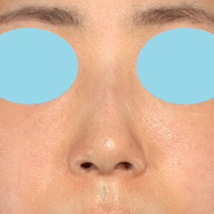 「鼻孔縁下降術」　新宿ラクル美容外科クリニック　山本厚志　３０代女性　手術後１ヶ月目　１月３日