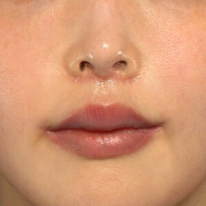 新宿ラクル美容外科クリニック　山本厚志　「人中短縮術（リップリフト）＋口角挙上（スマイルリップ）」　手術後１ヶ月目　１２月８日