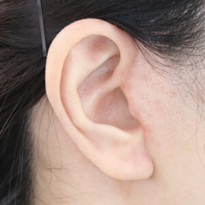 新宿ラクル美容外科クリニック　山本厚志　ナチュラルフェイスネックリフト　耳の傷痕　　手術後１ヶ月目　　１２月１２日