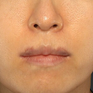 新宿ラクル美容外科クリニック　山本厚志　「外側人中短縮術（上口唇挙上術）修正 + 口角挙上（スマイルリフト）修正」　手術後１ヶ月目　１２月１３日