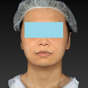 新宿ラクル美容外科クリニック　山本厚志　「アルテミスリフト＋ライポライフ脂肪吸引（メーラーファット+ジョールファット）」　手術後１ヶ月目　１２月１５日