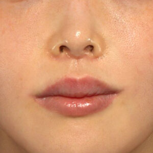 新宿ラクル美容外科クリニック　山本厚志　「人中短縮術（リップリフト）＋口角挙上（スマイルリップ）」　手術後２ヶ月目　１２月８日