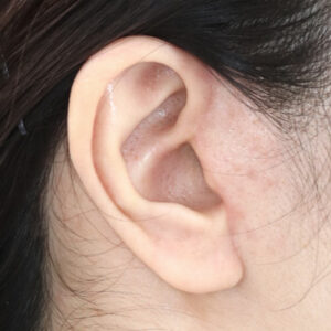 新宿ラクル美容外科クリニック　山本厚志　ナチュラルフェイスネックリフト　耳の傷痕　　手術後２ヶ月目　　１２月１２日