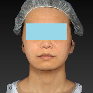 新宿ラクル美容外科クリニック　山本厚志　「アルテミスリフト＋ライポライフ脂肪吸引（メーラーファット+ジョールファット）」　手術後２ヶ月目　１２月１５日