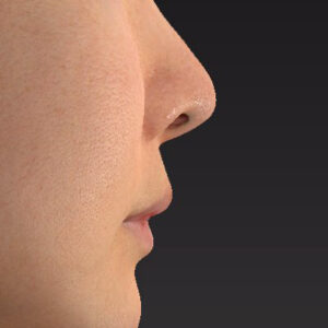 新宿ラクル美容外科クリニック　山本厚志　「猫手術（鼻唇角形成術）+ 貴族手術（鼻翼基部プロテーゼ）」　手術後６ヶ月目　４月５日