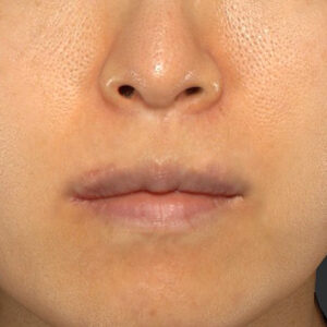 新宿ラクル美容外科クリニック　山本厚志　「外側人中短縮術（上口唇挙上術）修正 + 口角挙上（スマイルリフト）修正」　手術後６ヶ月目　４月８日