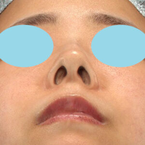 「鼻孔縁下降術」　新宿ラクル美容外科クリニック　山本厚志　３０代女性　手術前　１月３日