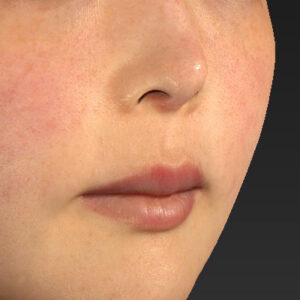 新宿ラクル美容外科クリニック　山本厚志　「人中短縮術（リップリフト）＋口角挙上（スマイルリップ）」　手術前　１２月８日